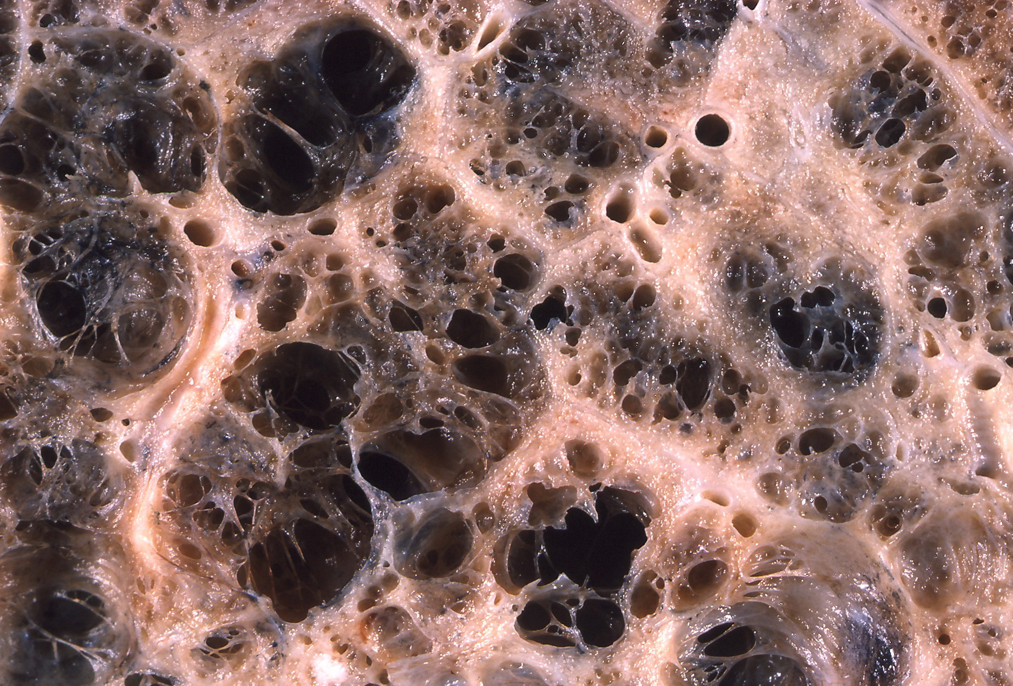 Emphysematous lung parenchyma (image from Wikipedia)
